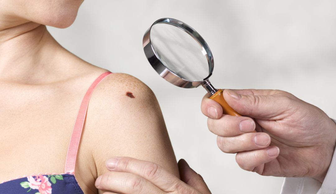 Cáncer: “Al año, Colombia podría registrar más de 26.000 casos de cáncer de piel”