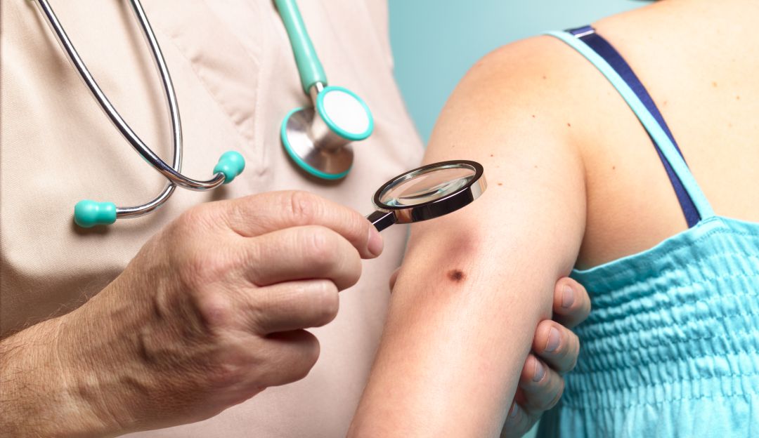 Anualmente, en el mundo se registra más de un millón 300 mil casos nuevos de cáncer de piel.