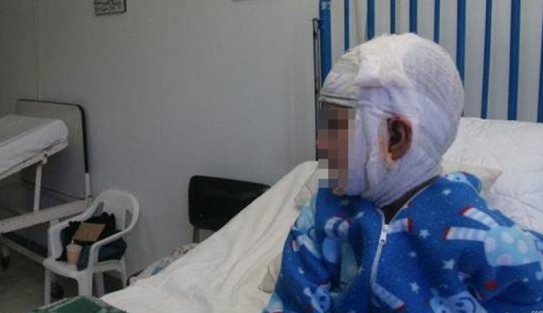 Quemaduras por cable de alta tensión: Menor con quemaduras por caída de cable de alta tensión pide ayuda