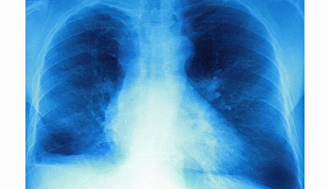 Secuelas del Covid-19: Pacientes Covid-19 podrían perder hasta el 80% de la capacidad pulmonar