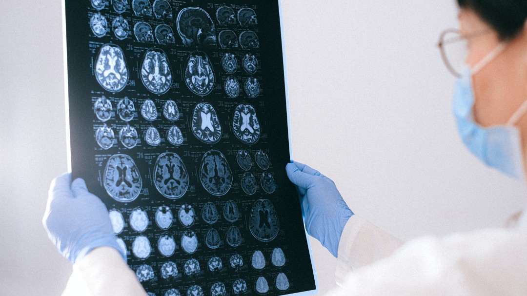 Conozca cómo detectar y actuar frente a un Ataque Cerebro Vascular