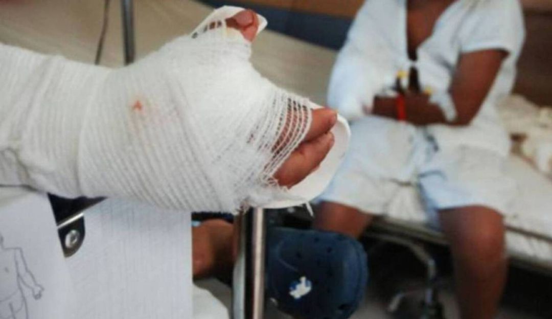 Quemados con pólvora en Risaralda: Joven de 19 años es el primer quemado con pólvora en Risaralda