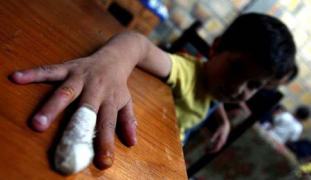 Quemados con pólvora: Siete quemados con pólvora en el Atlántico durante noche de velitas