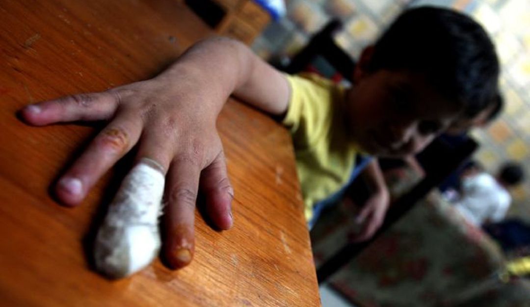 Quemados con pólvora en Maganguéc: Niño de cinco años resultó quemado con pólvora en zona rural de Magangué
