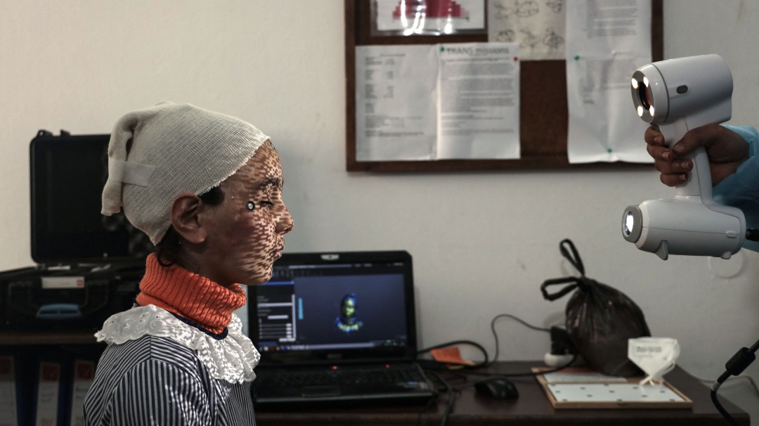 Máscaras impresas en 3D para curar rostros quemados en Gaza