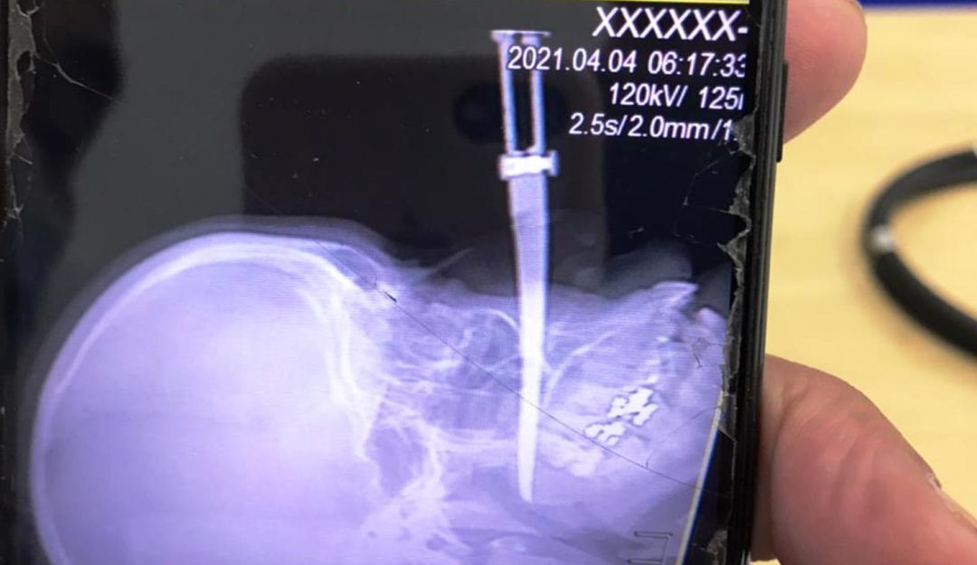 Atracadores hirieron con un cuchillo a una joven en el rostro y sobrevivió