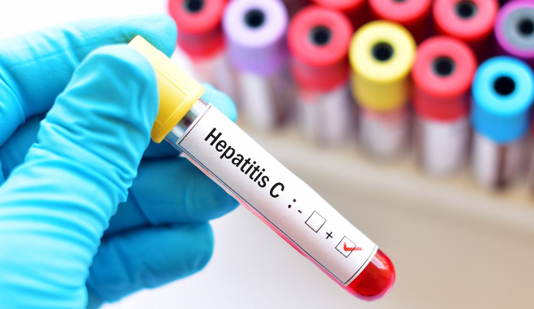 hepatitis C hepatitis C
