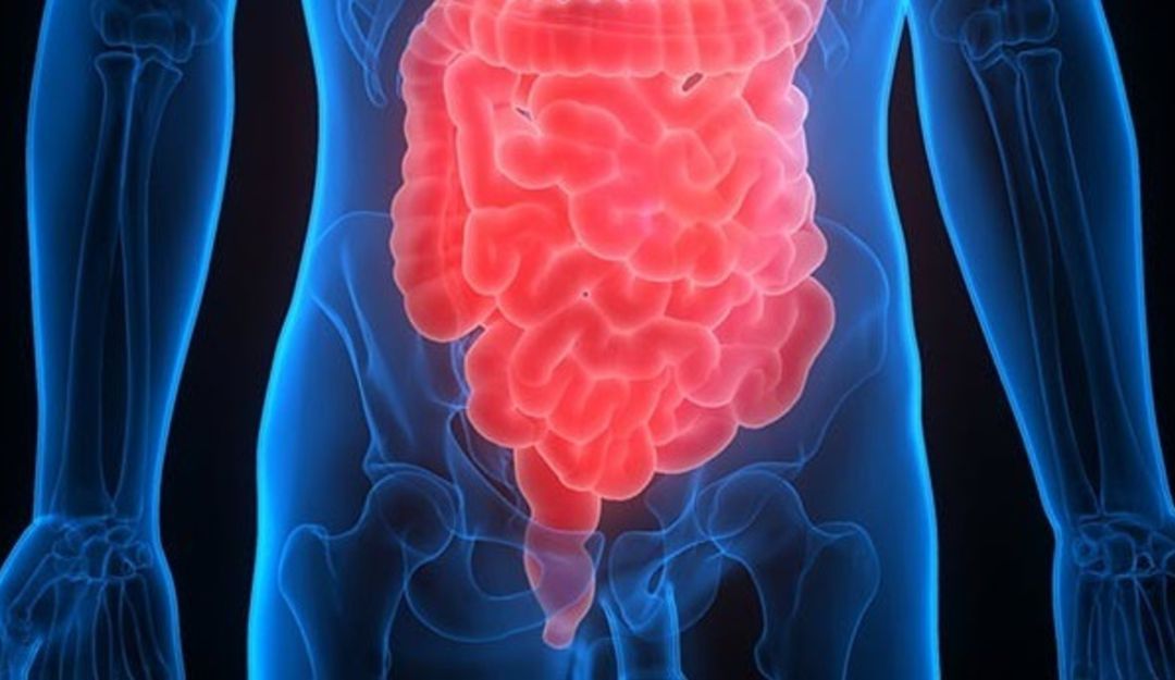 Cáncer de colon Cáncer de colon