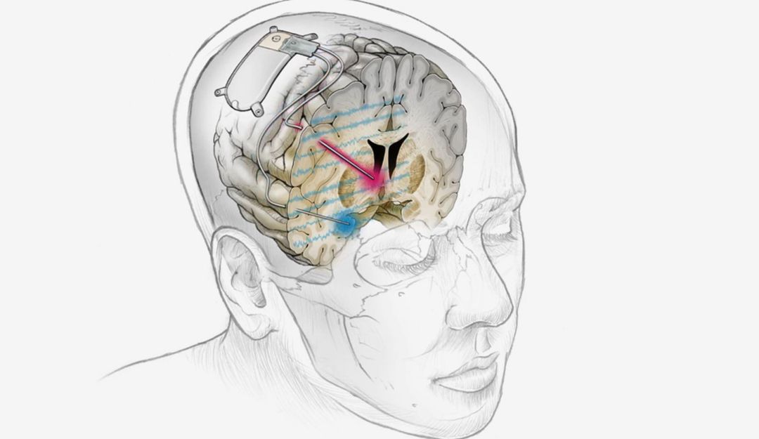 El dispositivo es implantado en el cerebro y permite tratar personas con depresión que son “resistentes” a terapias y medicinas. El dispositivo es implantado en el cerebro y permite tratar personas con depresión que son “resistentes” a terapias y medicinas.