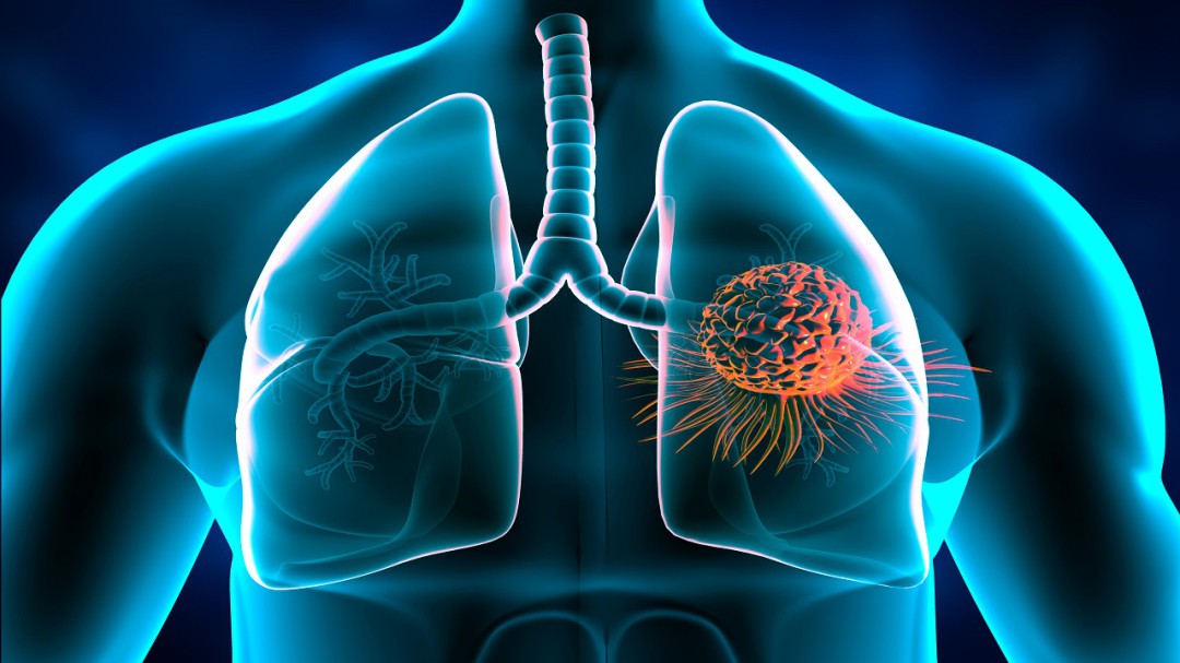 Cáncer de pulmón, más allá del tabaquismo
