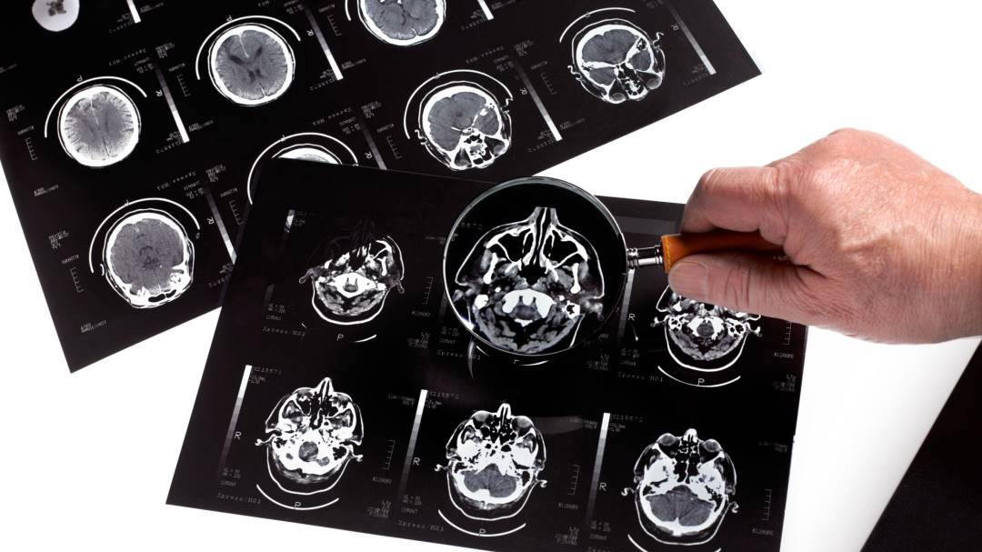 Un fármaco para el corazón podría tratar el Alzheimer