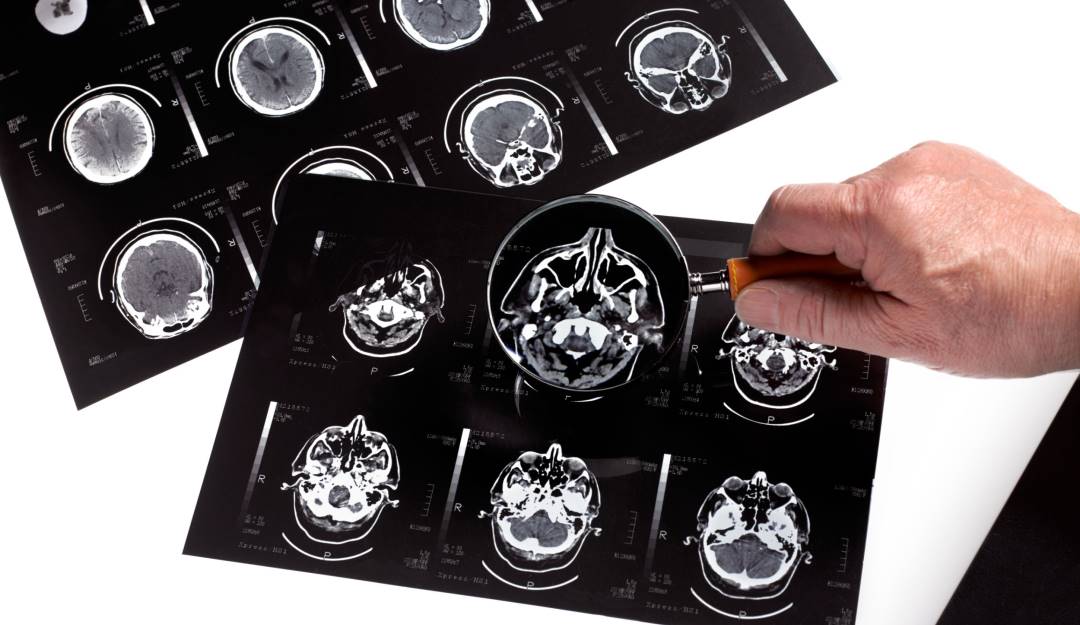Radiografías cerebrales. Foto: Getty Radiografías cerebrales. Foto: Getty