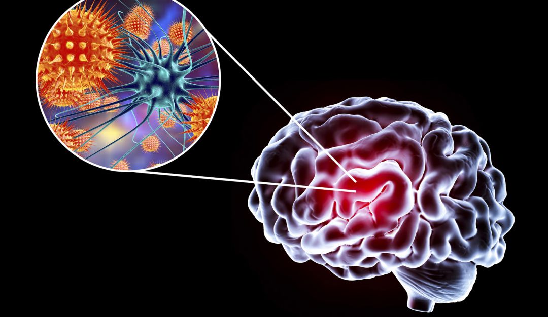 ¿Cómo afecta la COVID-19 al sistema nervioso aún después de superarse? ¿Cómo afecta la COVID-19 al sistema nervioso aún después de superarse?