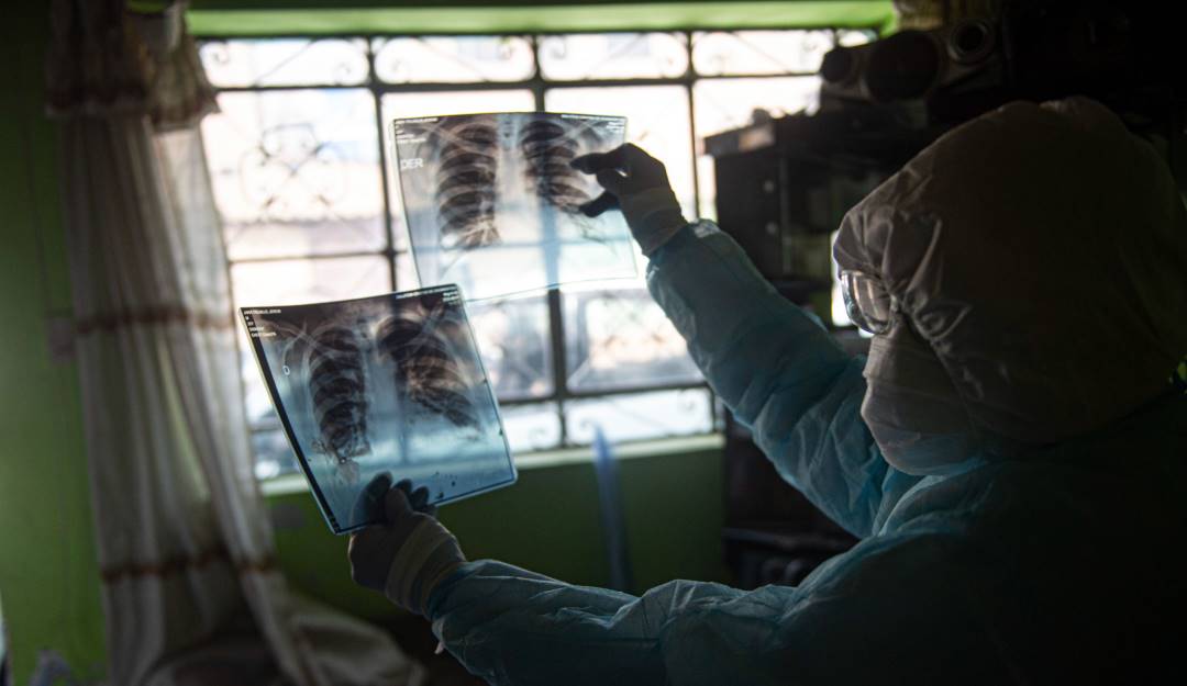Revisión de radiografías pulmonares en Lima (Perú). Foto: Getty Revisión de radiografías pulmonares en Lima (Perú). Foto: Getty