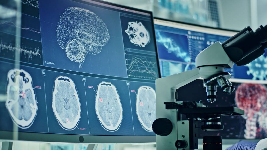 Impacto de COVID-19 grave equivale a envejecimiento cerebral de 20 años