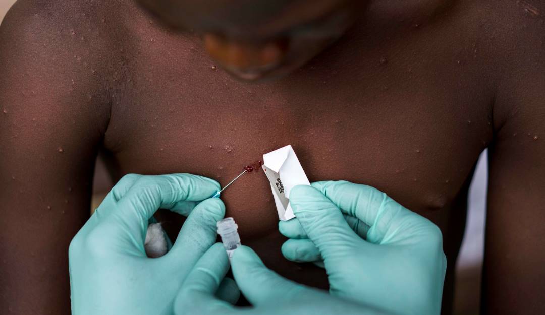 Toma de muestras para el estudio de la viruela del mono en África. Foto: Getty Toma de muestras para el estudio de la viruela del mono en África. Foto: Getty