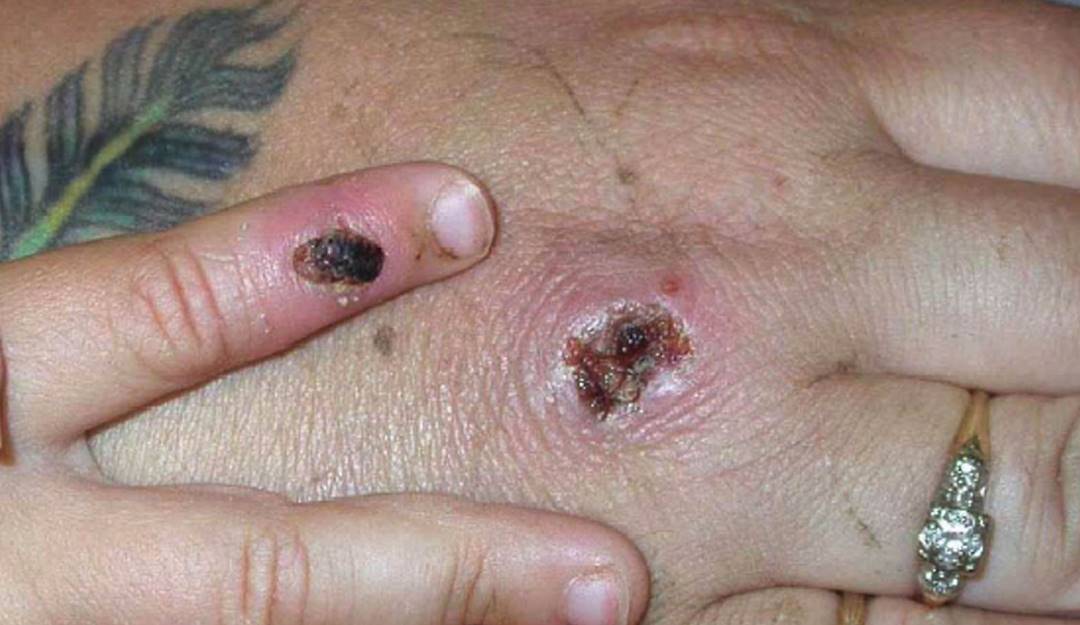 Lesiones en la piel tras contagio con viruela del mono. Foto: Getty Lesiones en la piel tras contagio con viruela del mono. Foto: Getty