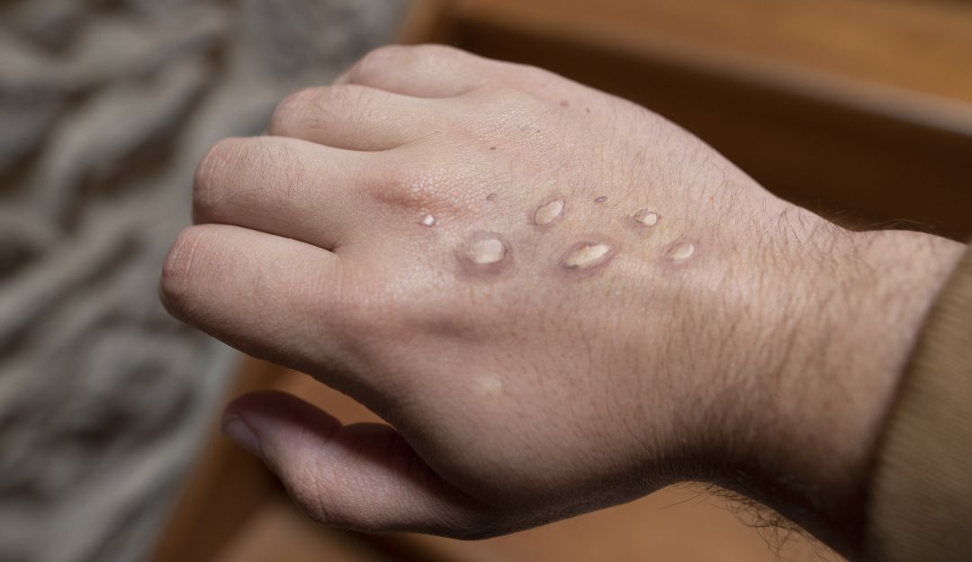 ¿Cuáles son los síntomas de la viruela del mono? ¿Cuáles son los síntomas de la viruela del mono?