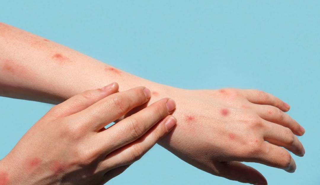 De acuerdo con el Instituto Nacional de Salud, a la fecha en Colombia se han detectado 20 casos de esta patología De acuerdo con el Instituto Nacional de Salud, a la fecha en Colombia se han detectado 20 casos de esta patología