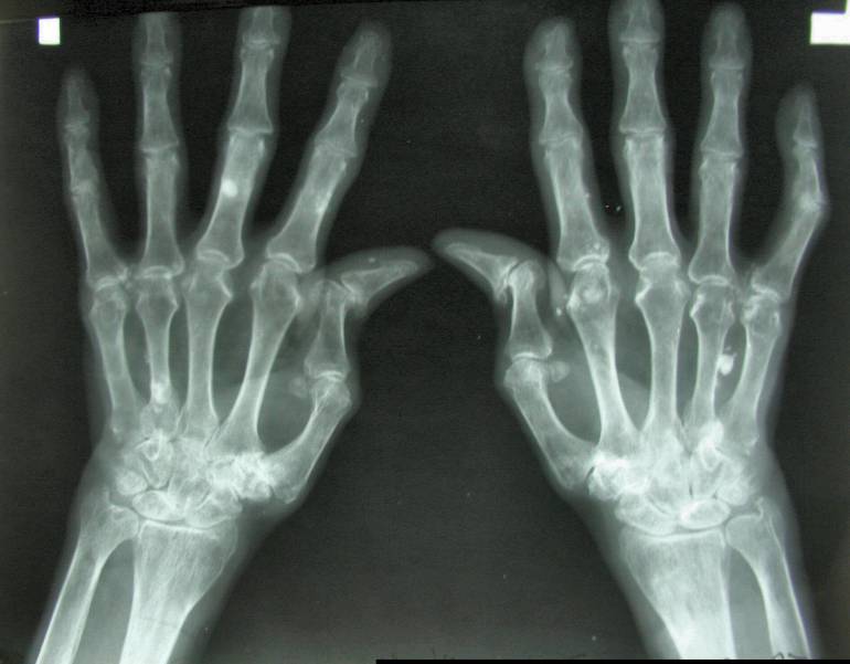 Artritis Reumatoide Una De Las Causas Mas Comunes De Discapacidad Y Perdida De Empleo Sanamente Caracol Radio