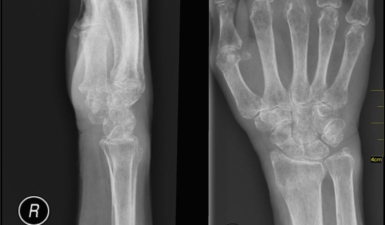 Columna en osteoporosis la la como tratar