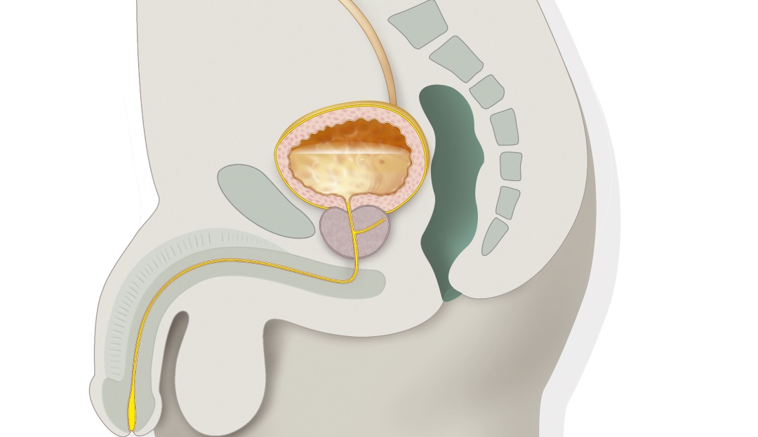 ¿Qué sucede cuando eres precanceroso para la próstata? ¿Qué sucede cuando eres precanceroso para la próstata?